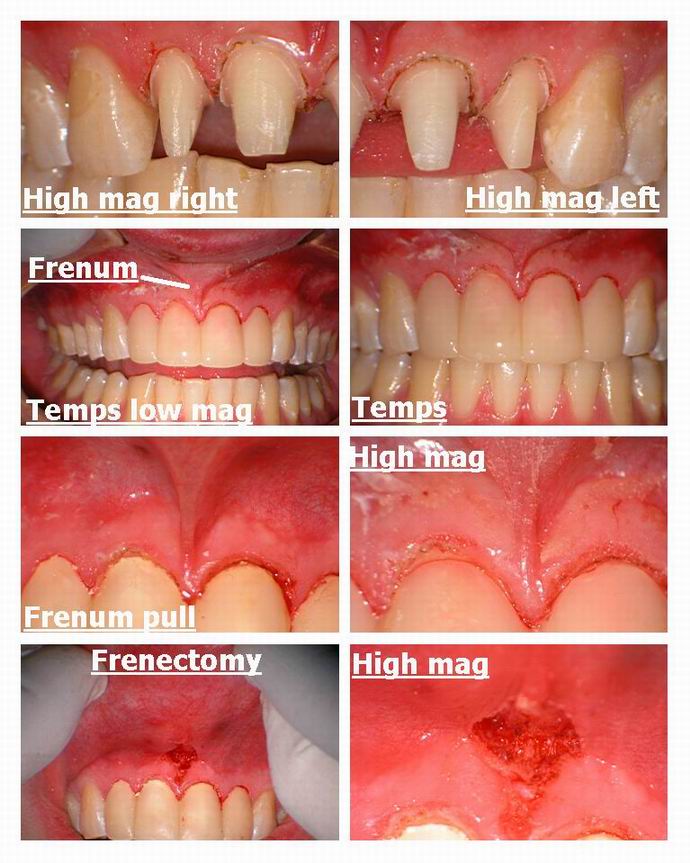 Resize of Laser recontouring with erbium pg 4.jpg